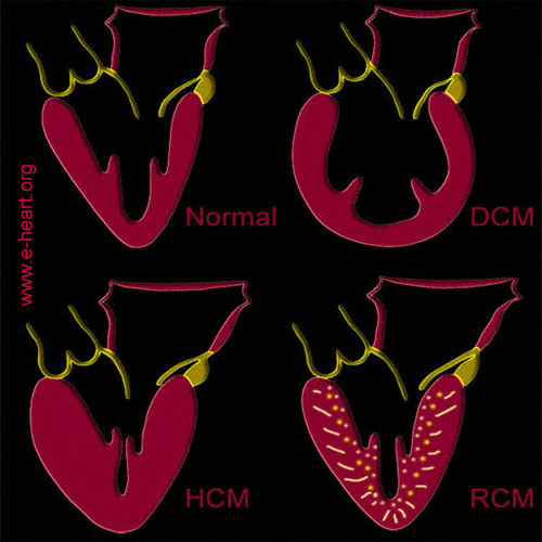 Cardiomyopathies Cartoon